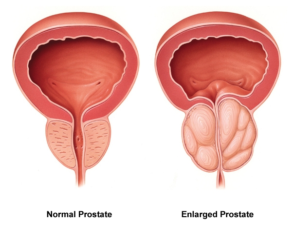 prostat nedir